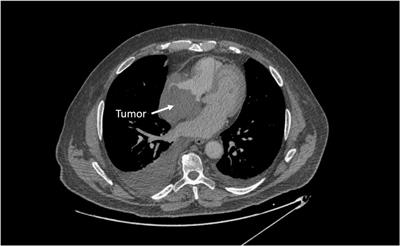 Case report: Primary cardiac lymphoma manifesting as superior vena cava syndrome
